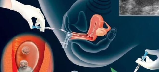 Тянет живот после переноса эмбрионов