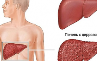 Цирроз печени симптомы у мужчин