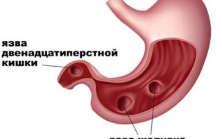 Обострение язвы желудка и симптомы