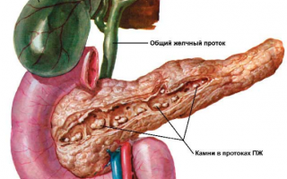 Панкреатит симптомы и его лечение