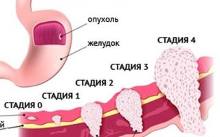 Рак желудка 3 стадия сколько живут