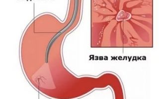 Как лечить язву желудка