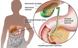 Калькулезный холецистит лечение и диета