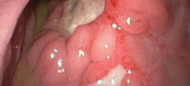 Малигнизация язвы желудка и 12-перстной кишки