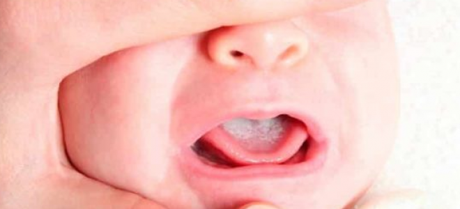 У ребенка болит язык и температура
