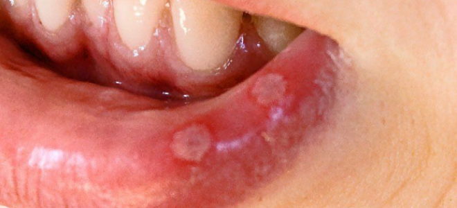 Стоматит на губе лечение у ребенка