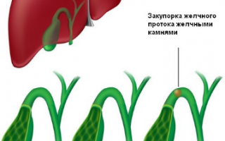 Калькулезный холецистит хронический
