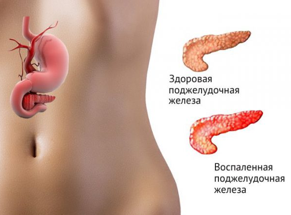 Признаки заболевания поджелудочной железы у мужчин