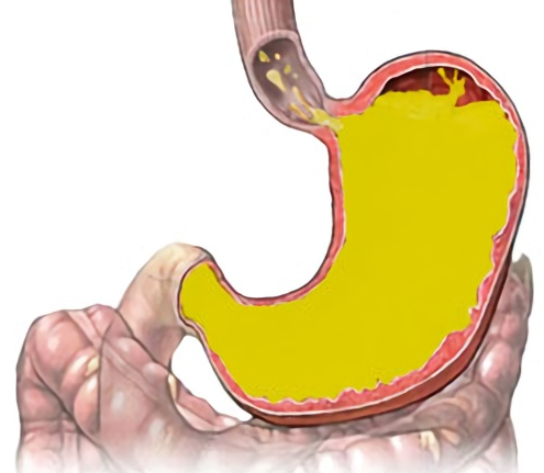 Желчный пузырь заброс желчи в желудок