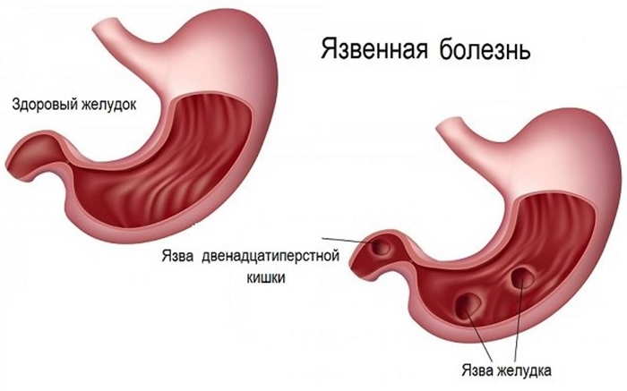 Язва желудка и кишечника